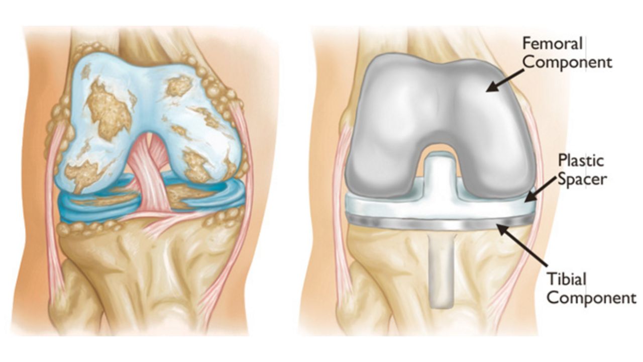 TOTAL-KNEE-REPLACEMENT