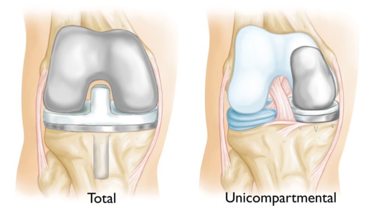 Unicondylar-Knee-Replacement