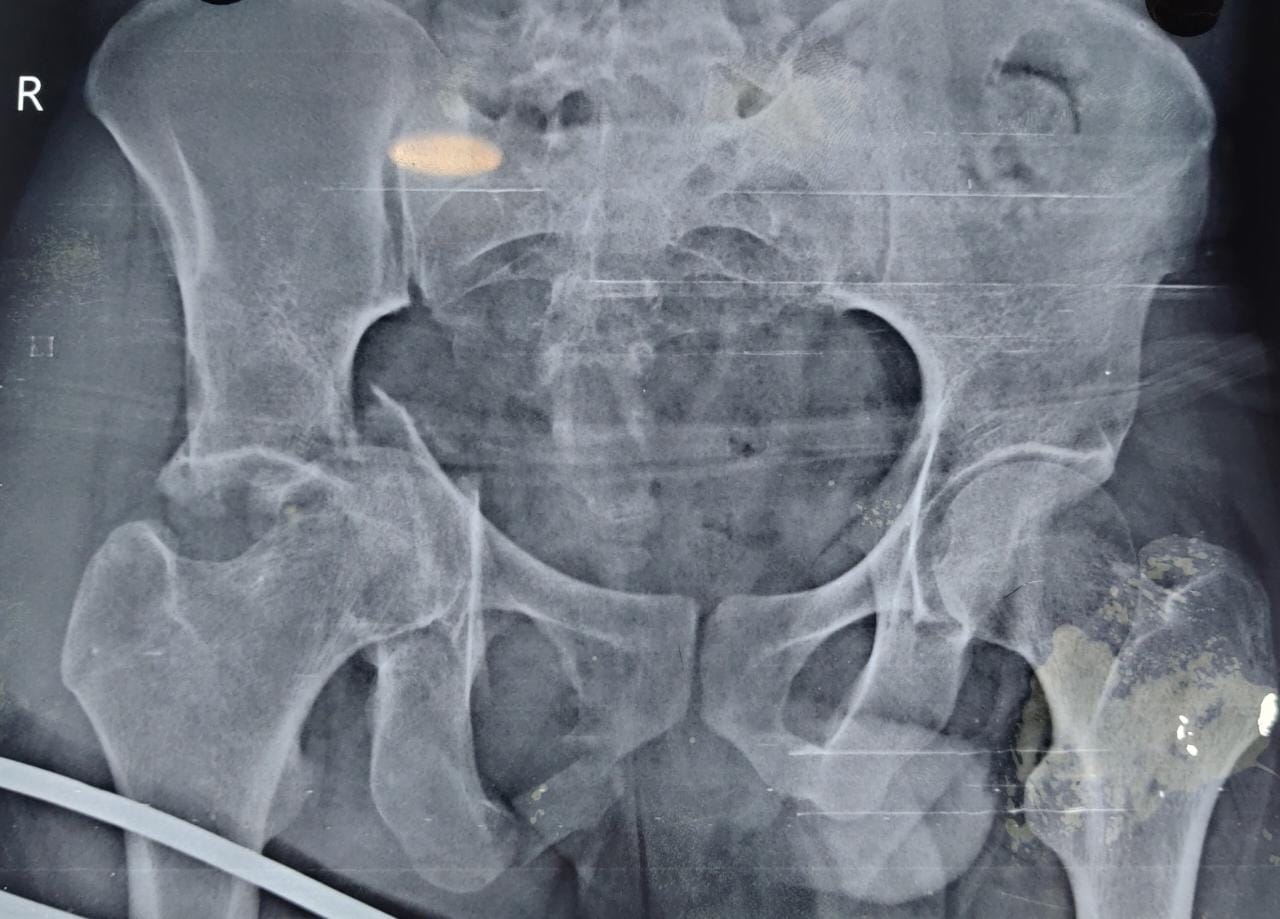 hip xray