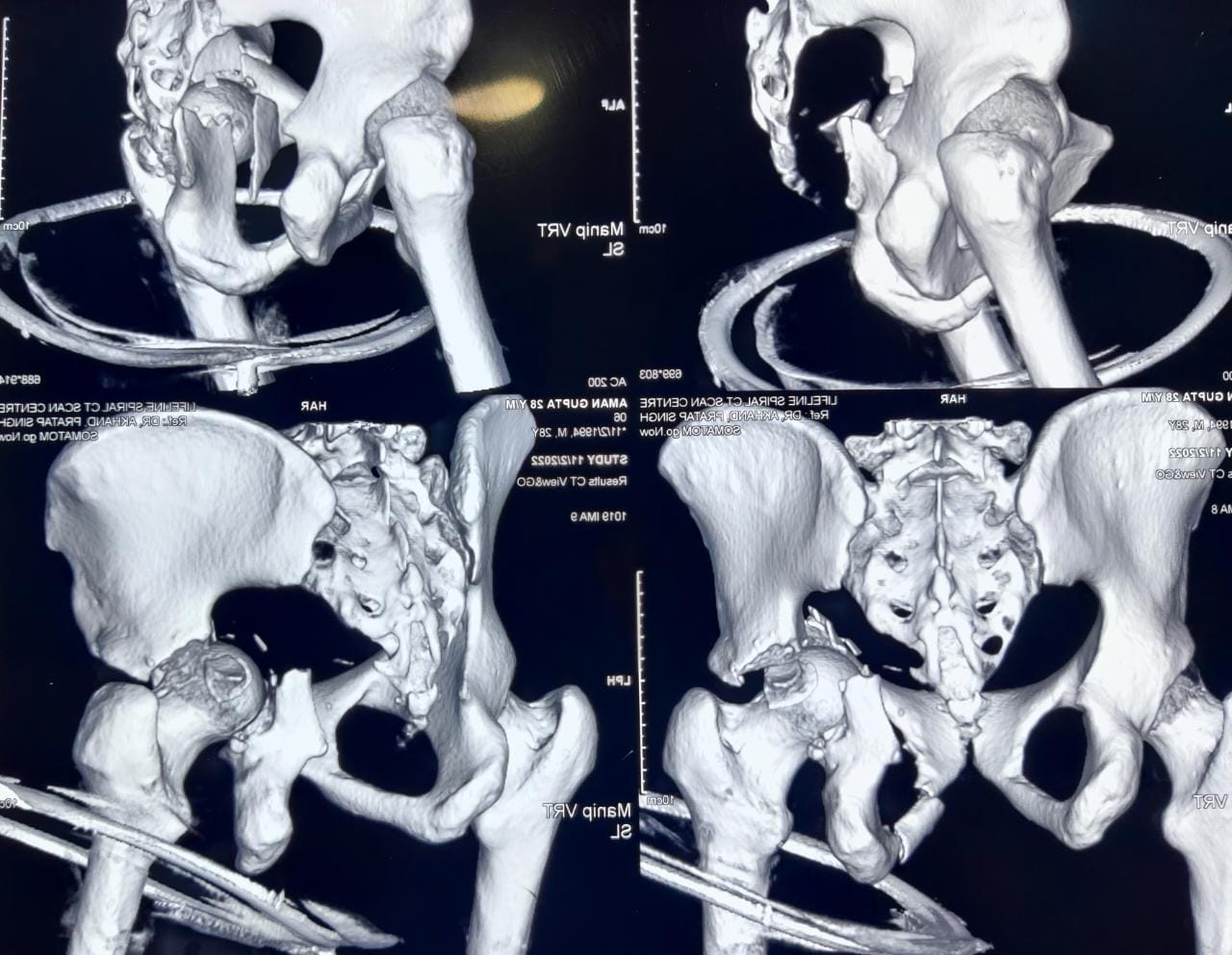 hip xray