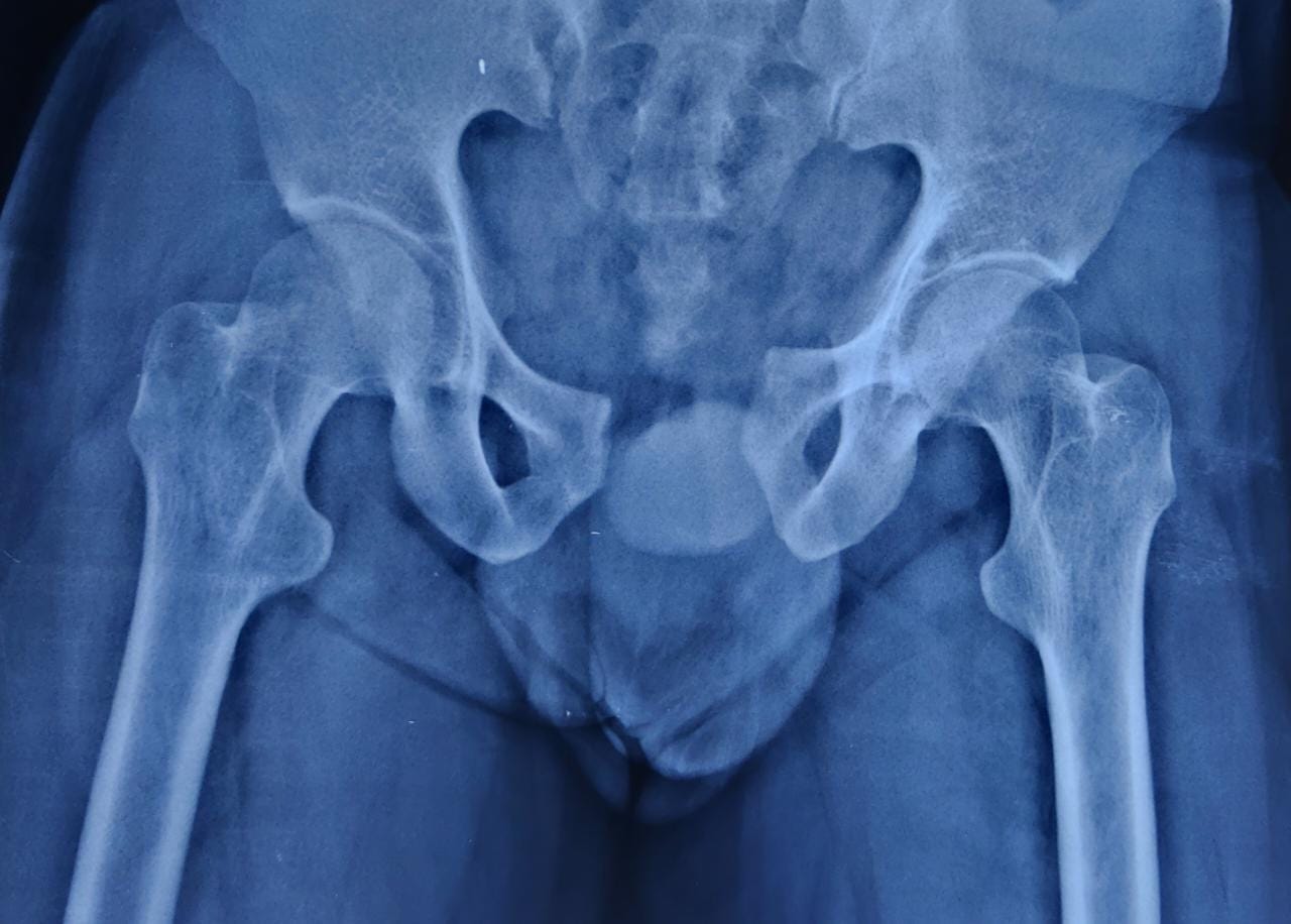 hip xray