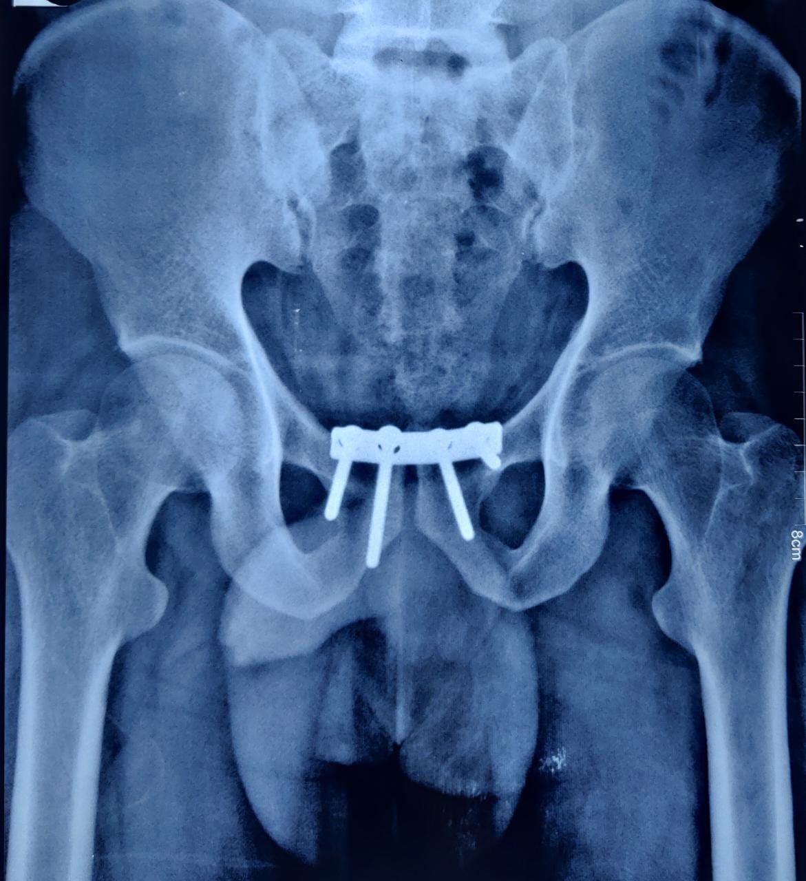 hip xray